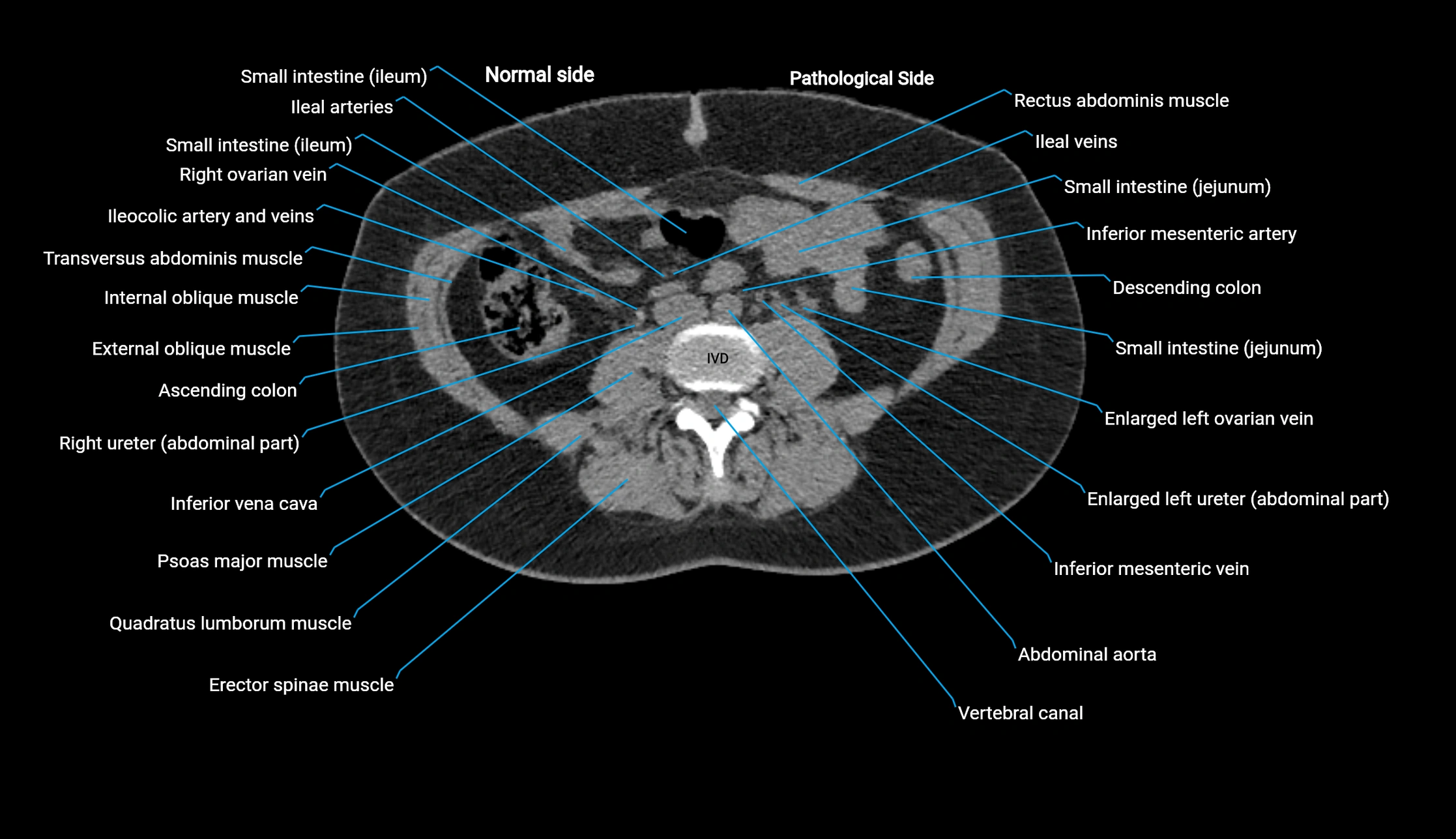CT KUB axial cross sectional anatomy  radiology image -img-00201-00079.webp